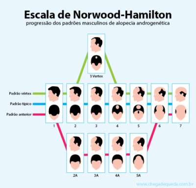 Escala Norwood Calvície Masculina