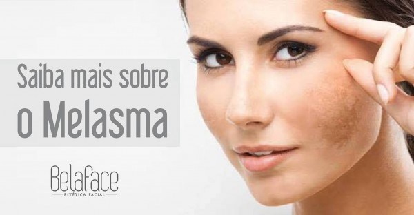 Melasma Sintomas Causas Tratamentos